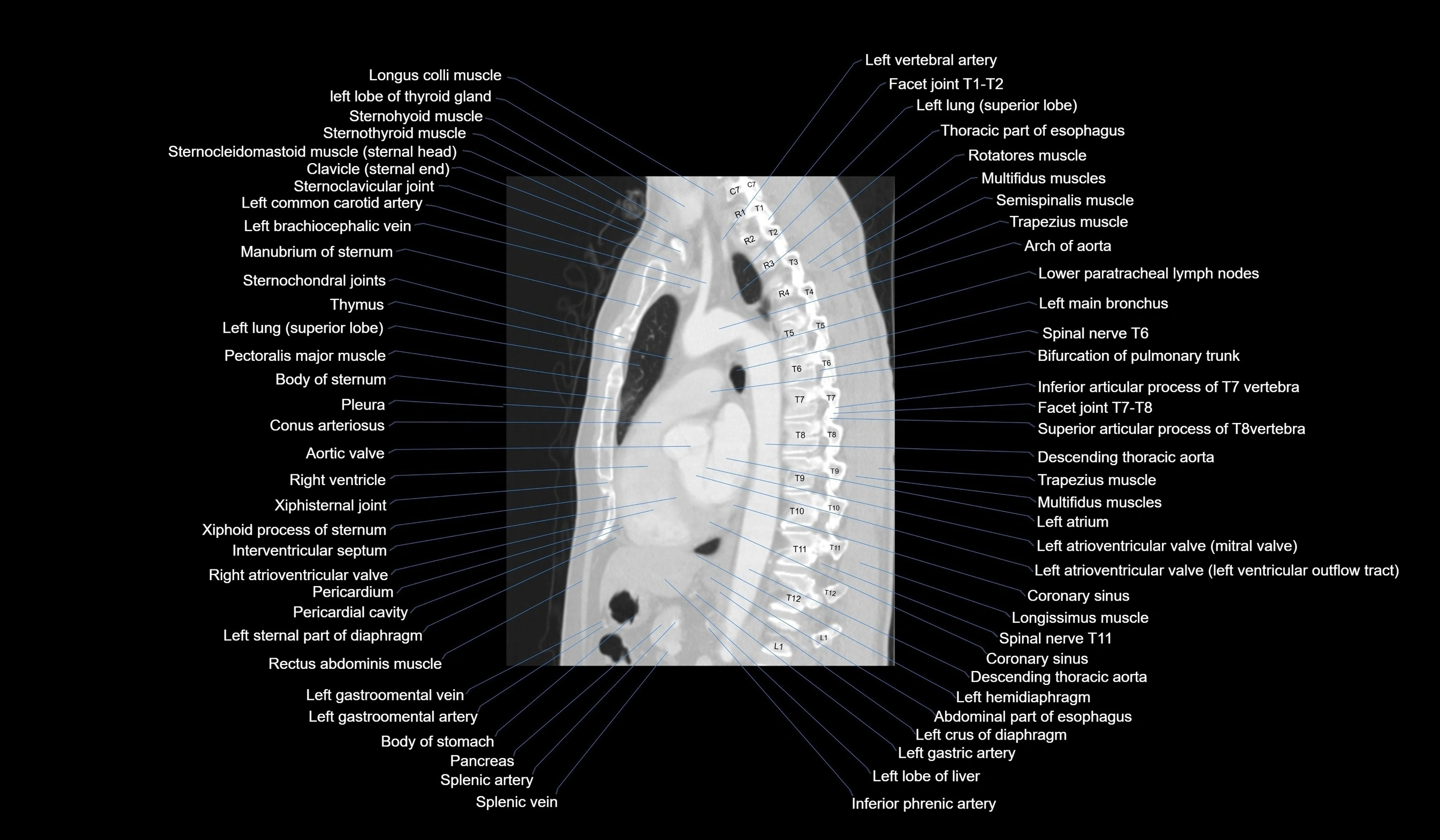 CT chest (thorax) labelled sagittal cross sectional anatomy radiology image-00080.webp